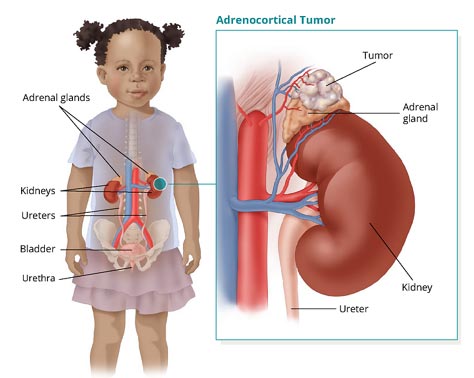 Adrenal Tumors in Children